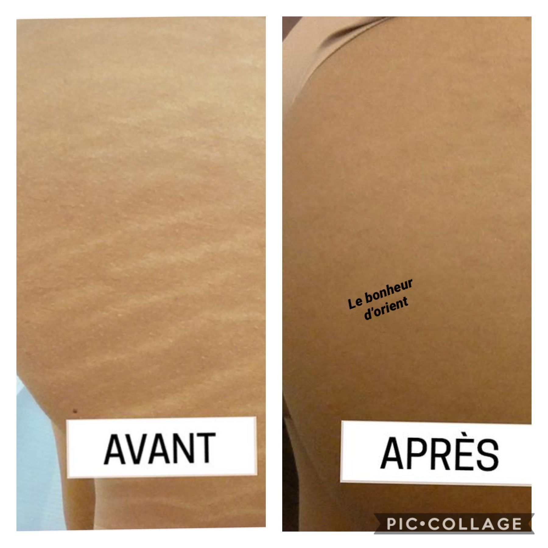 Image comparative montrant la peau avant et après un traitement pour les vergetures, avec les étiquettes 'AVANT' et 'APRÈS'.